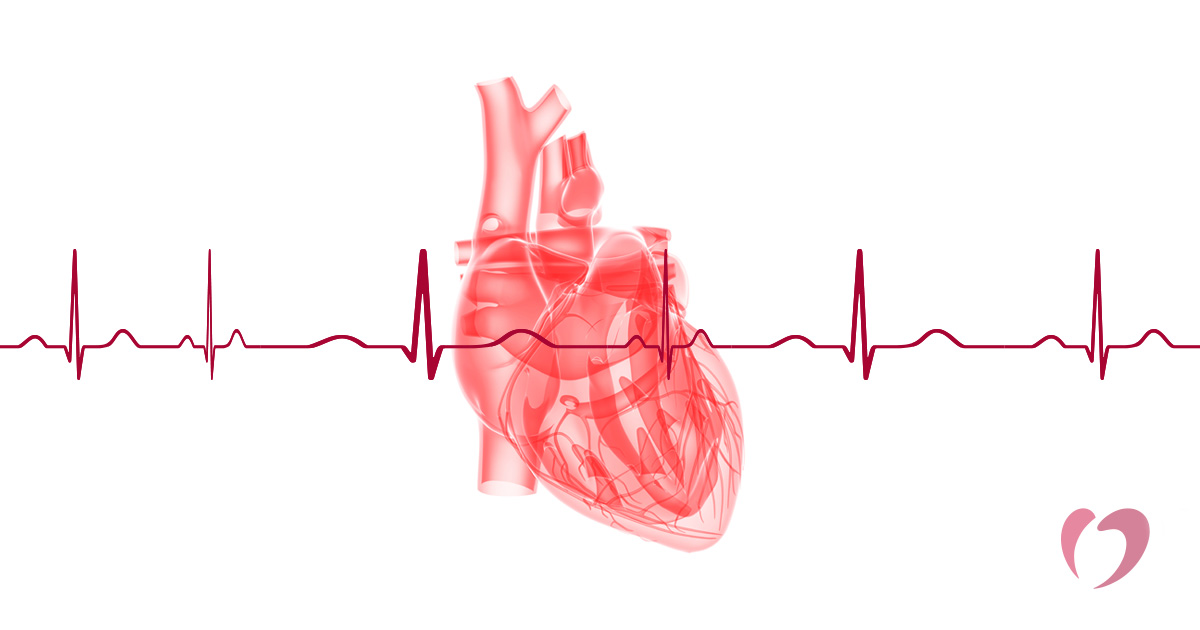 Cardiac arrhythmia illustration